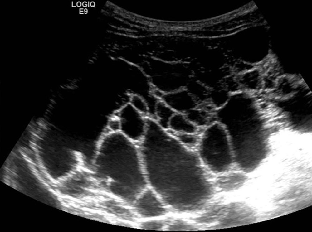 Sonographic appearance of an abdominal macrocystic lymphatic malformation