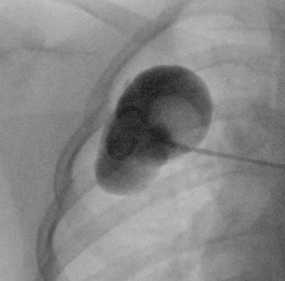 Macrocystic lymphatic malformation on the right chest
