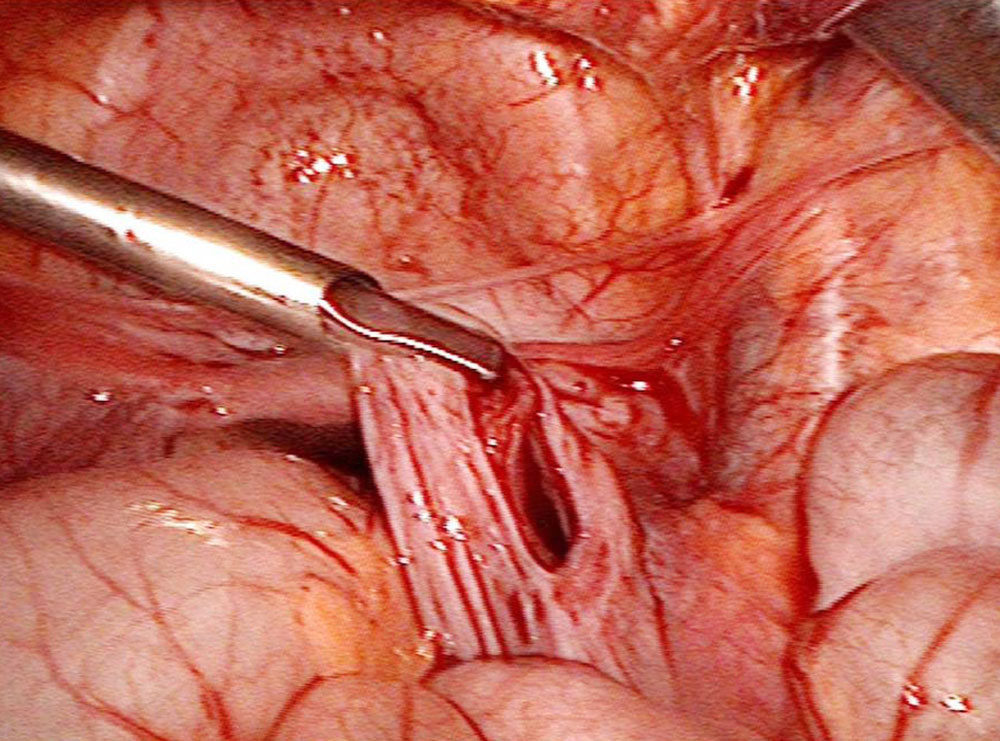 Laparoscopic resection of a retroperitoneal lymphatic malformation