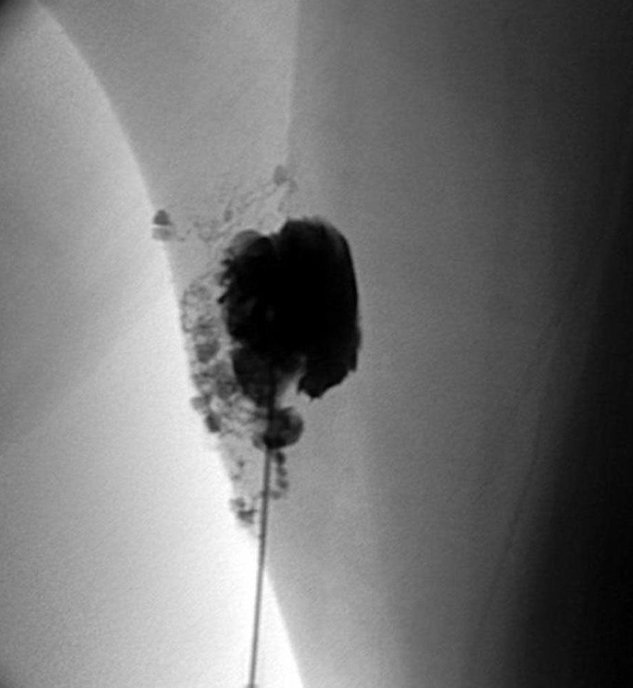 Sclerotherapy on X-ray after contrast injection into the cysts