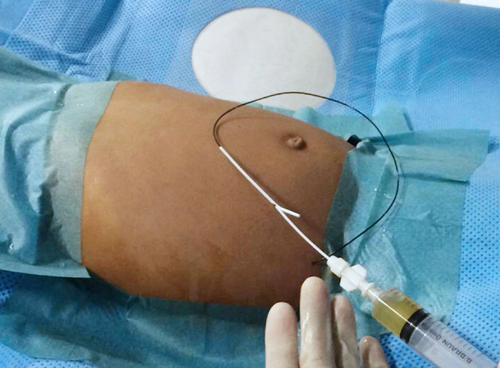 Intraoperative image of sclerotherapy of a large abdominal lymphatic malformation