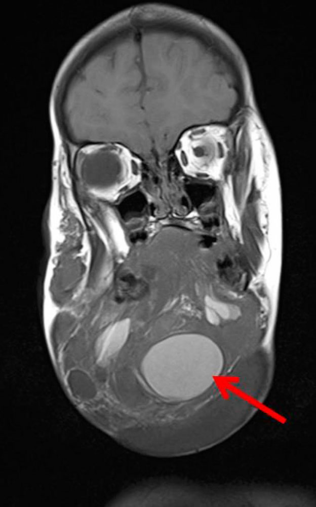 MRI – Macrocystic lymphatic malformation of the neck