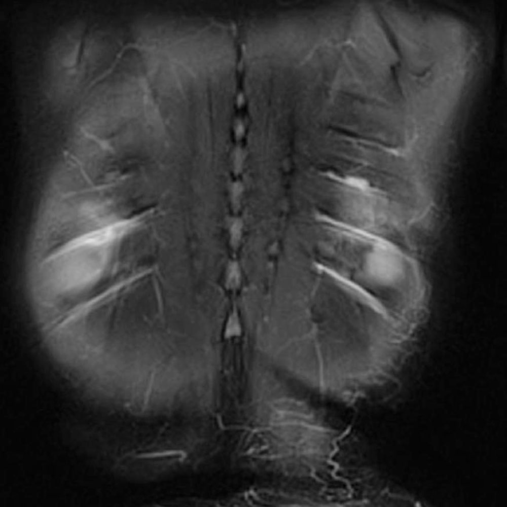 MRI – Lymphatic collateral pathways