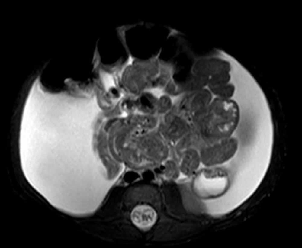 MRI – Lymphatic chylous ascites