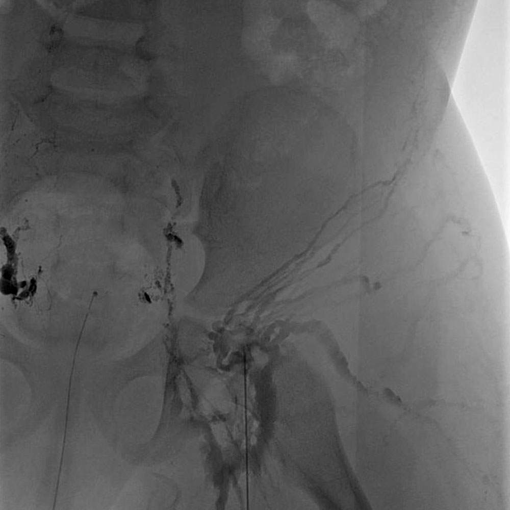 Intranodal lymphangiography – Dilatation of the lymphatic ducts