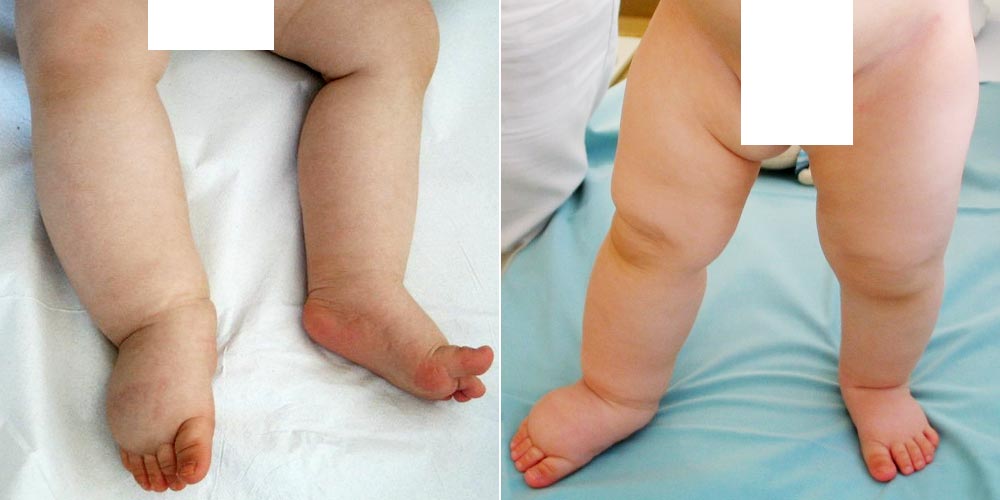 Patient with primary lymphedema
