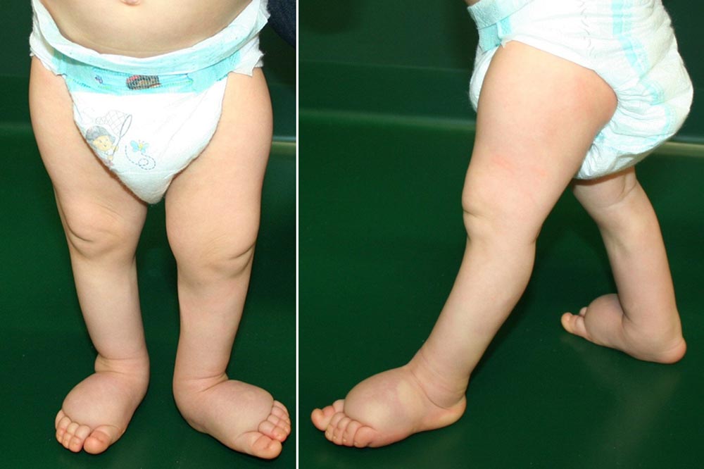 Congenital lymphedema of the legs