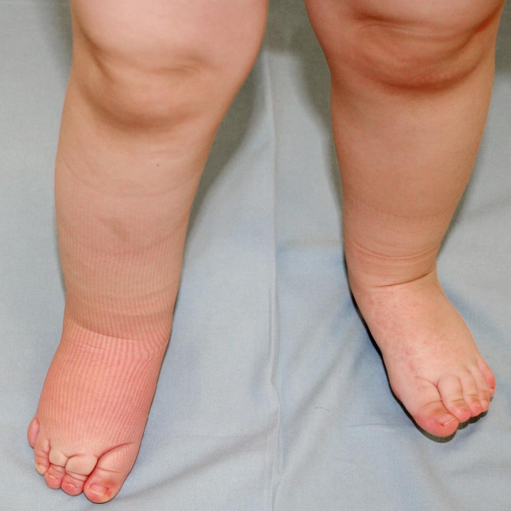 Asymmetric swelling at lymphedema