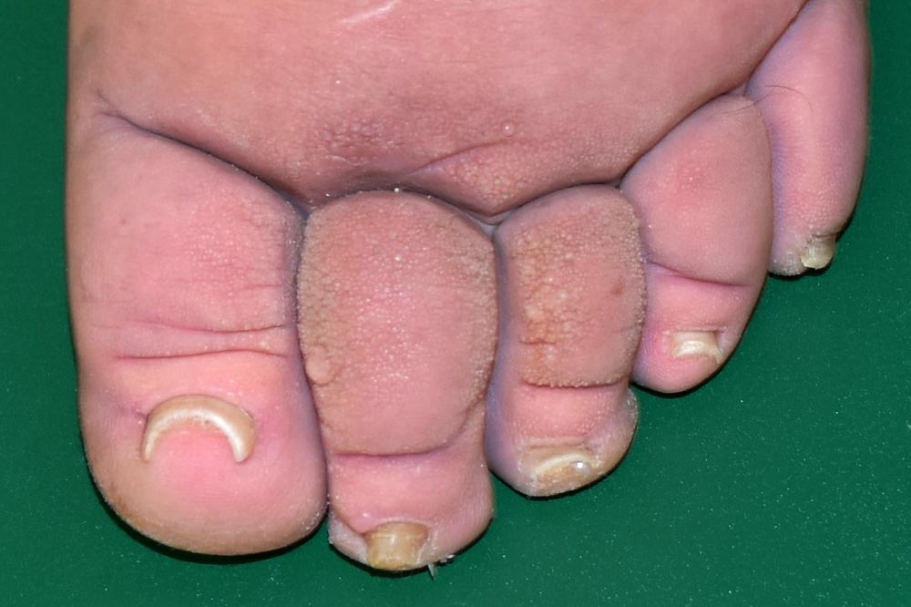 Advanced lymphedema