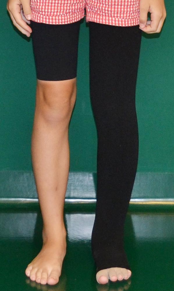 Customized compression garment