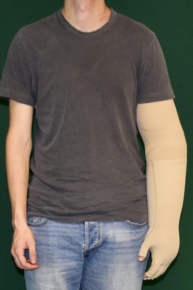 Customized compression garment