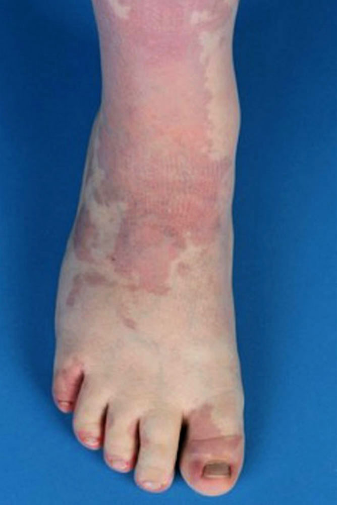 Capillary malformation on the right leg