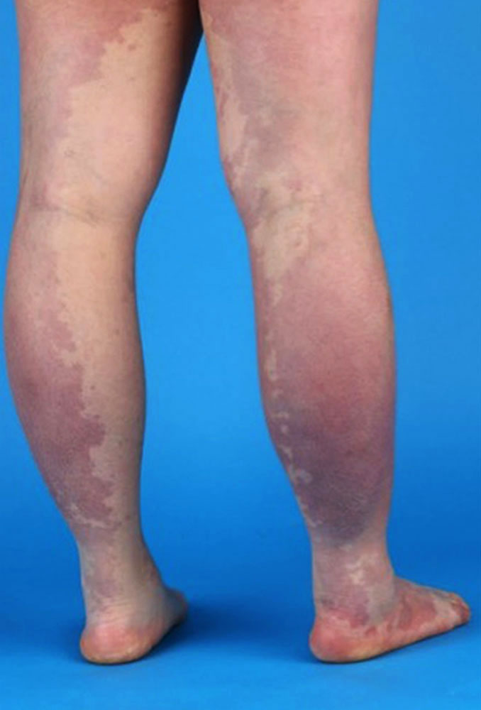 Capillary malformation on both legs