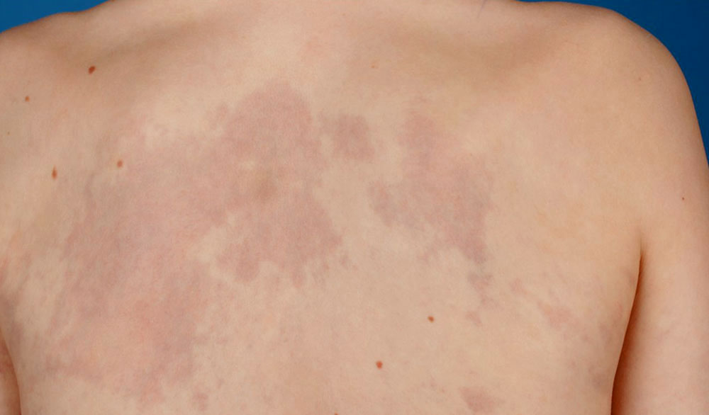 Capillary malformation on the back
