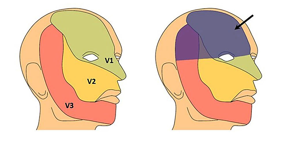 Distribution pattern of facial capillary malformations.