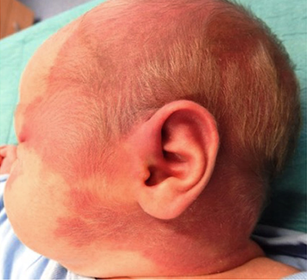 Capillary malformation in the head and neck region