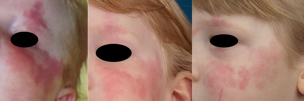 Capillary malformation at the face