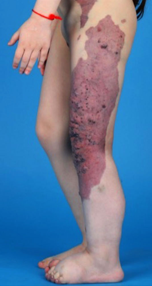 Klippel-Trénaunay syndrome with dark blue-reddish capillary malformation