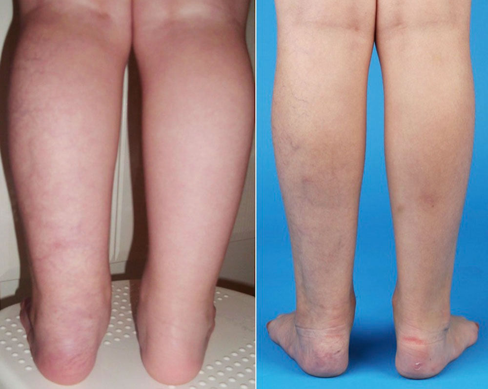 Capillary malformation with mild hyperplasia of the left lower extremity