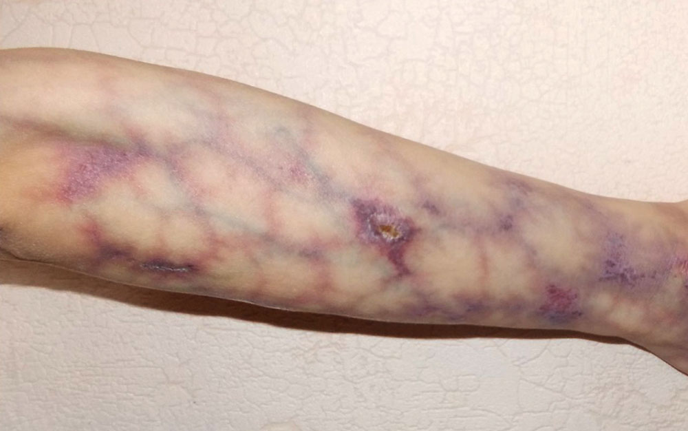 Extensive CMTC on the forearm