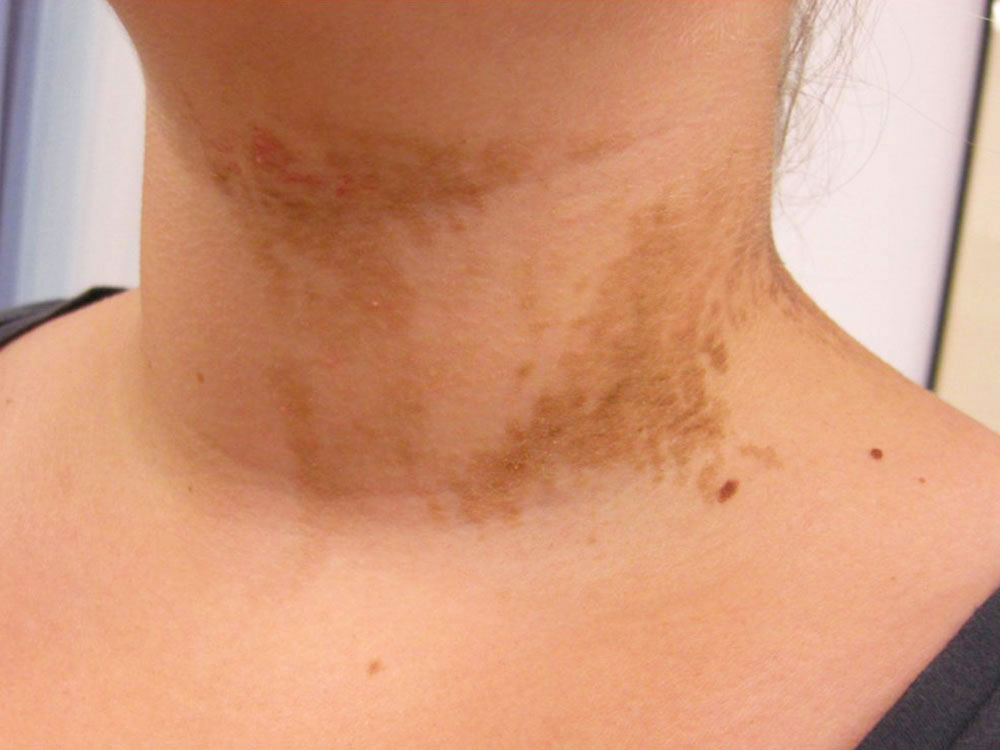 Epidermal nevus on the neck