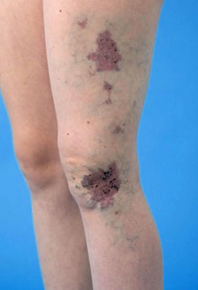 Capillary malformation in Klippel-Trénaunay syndrome
