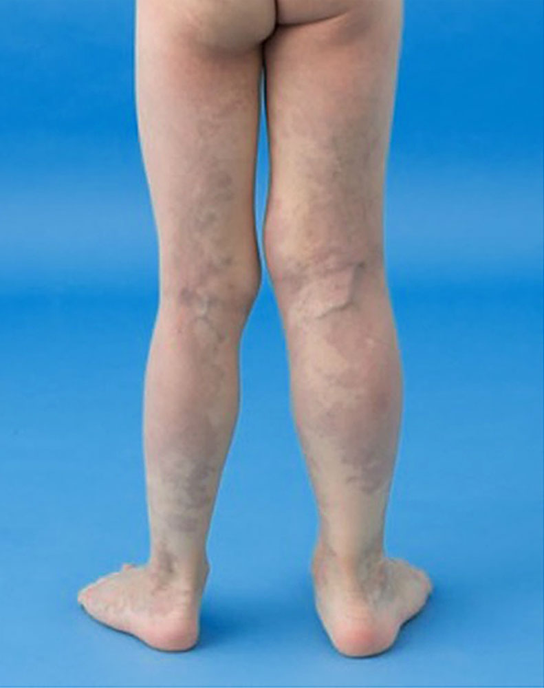 Klippel-Trénaunay syndrome of the legs
