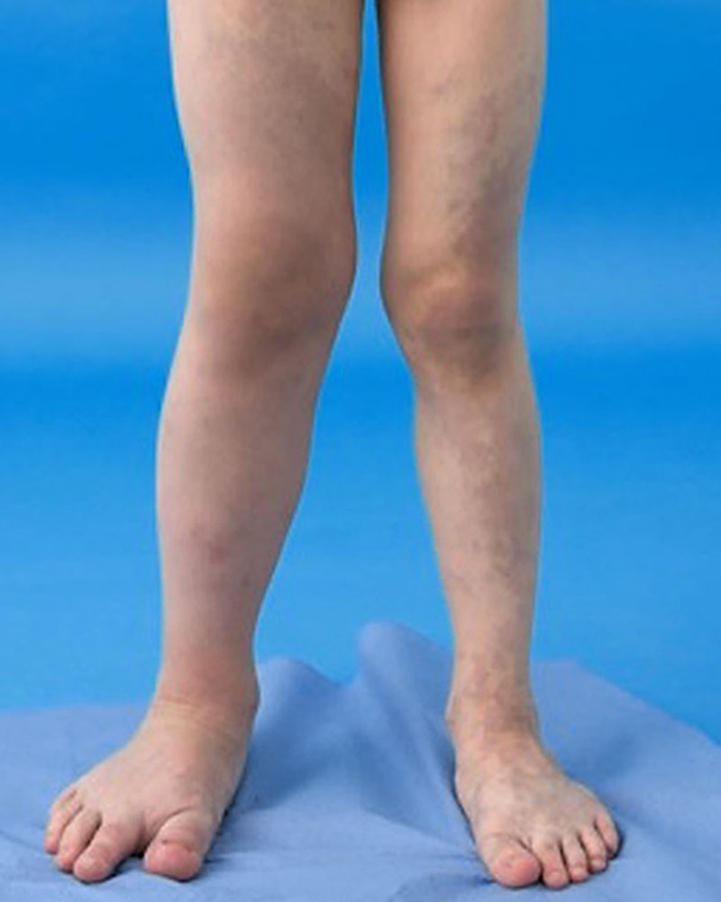 Klippel-Trénaunay syndrome of the legs