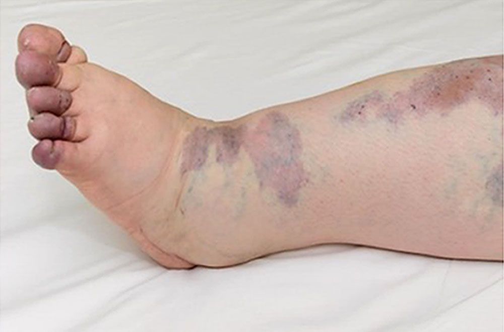 Lymphedema of the distal lower extremity and toes