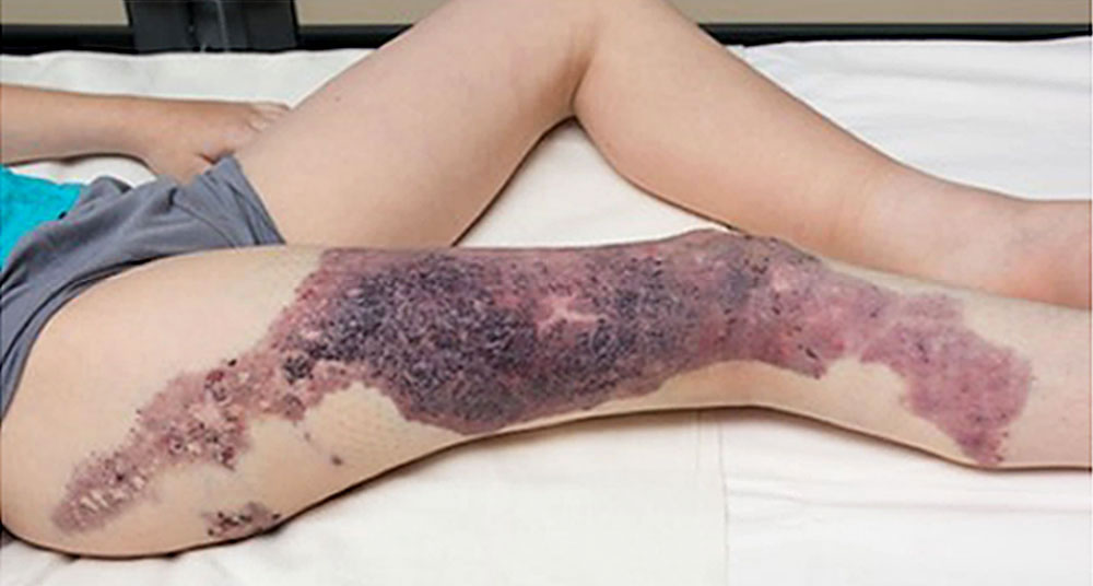 Klippel-Trénaunay syndrome