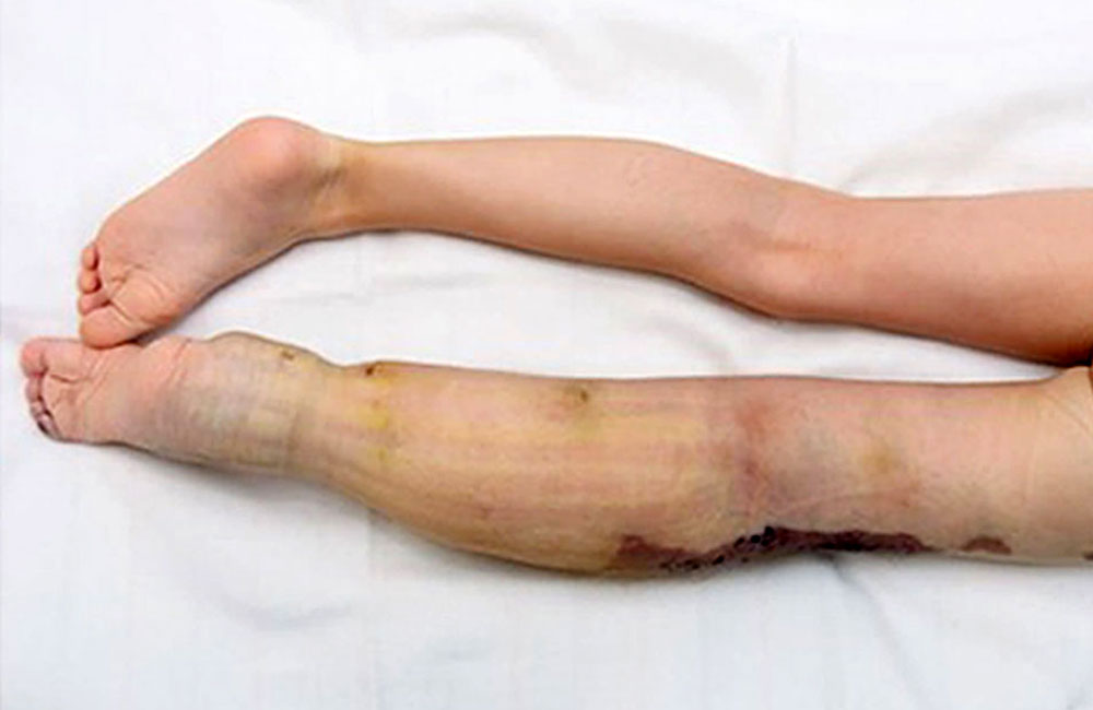 Klippel-Trénaunay syndrome