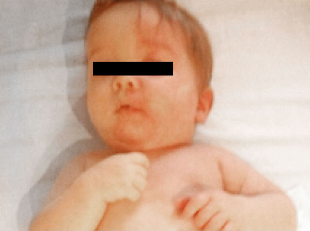 Infant with Sturge-Weber syndrome