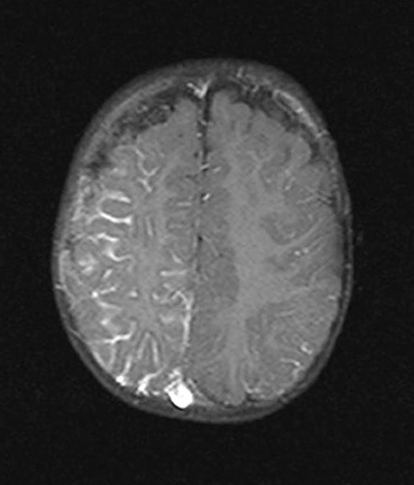 MRI – Leptomeningeal angiomatosis in Sturge-Weber syndrome
