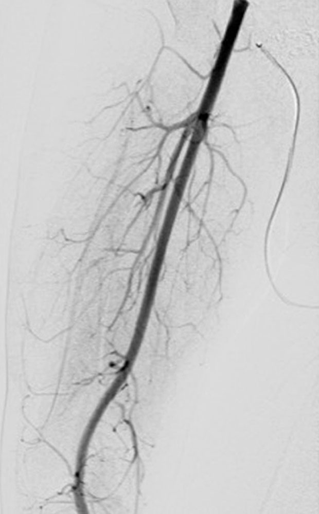 Arteriovenous fistulas Parkes Weber syndrome