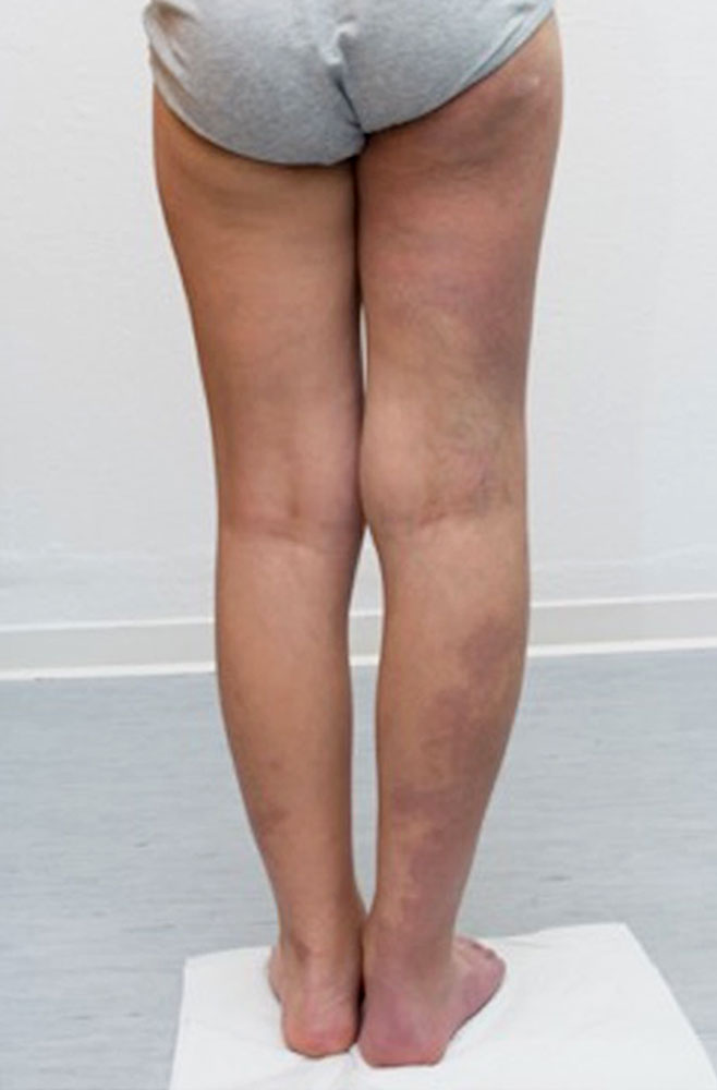 Diffuse capillary malformations with overgrowth on the right leg