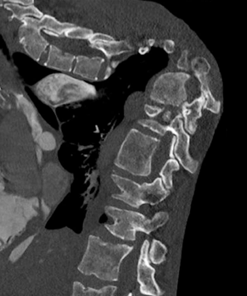 Computed tomography in Proteus syndrome