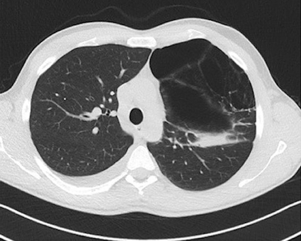 Lung cysts on computed tomography