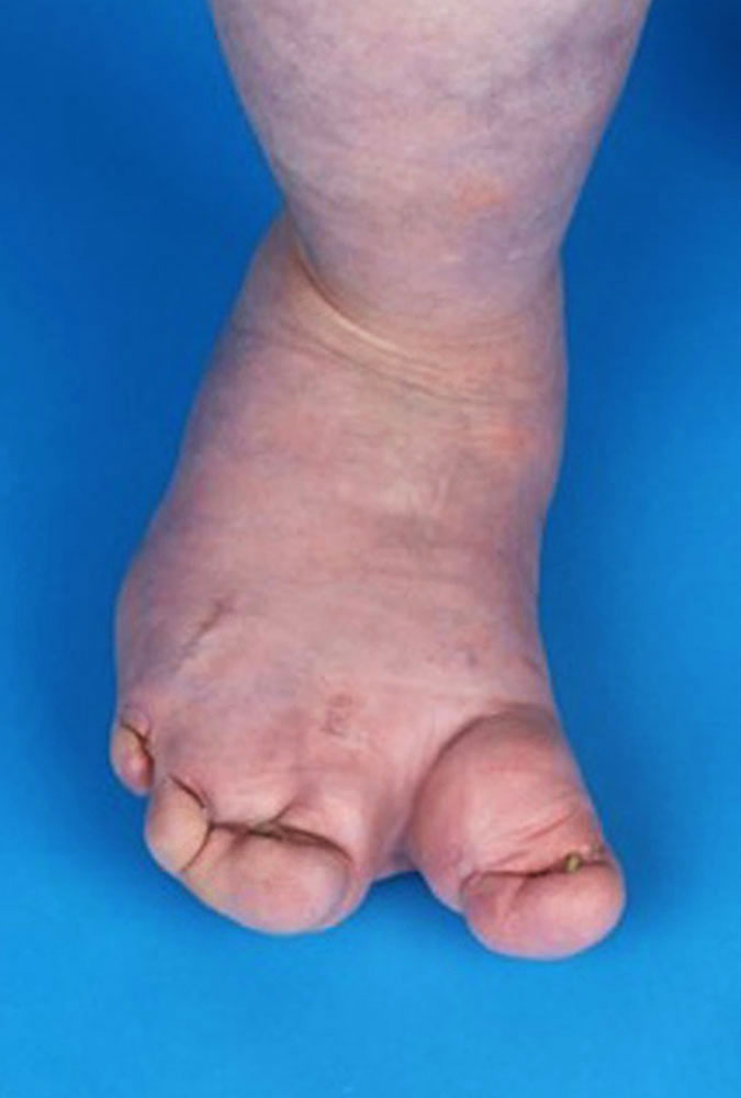 Ballooning hyperplasia of the right foot and toes in CLOVES syndrome