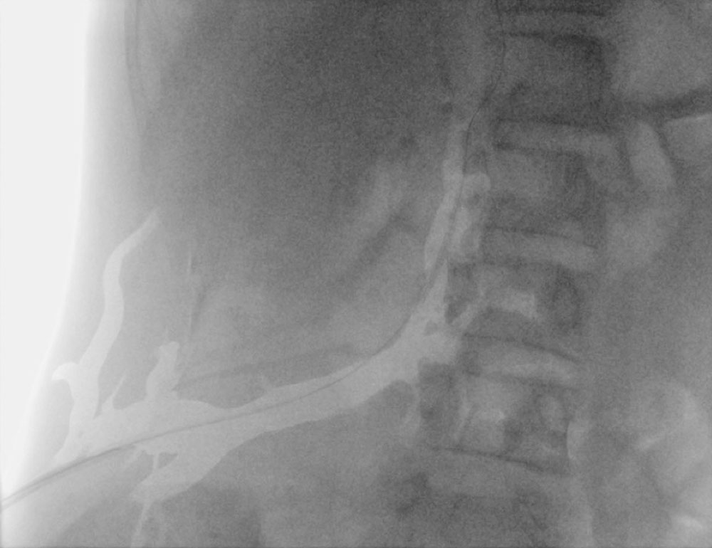 Large-lumen, abdominal marginal vein in CLOVES syndrome