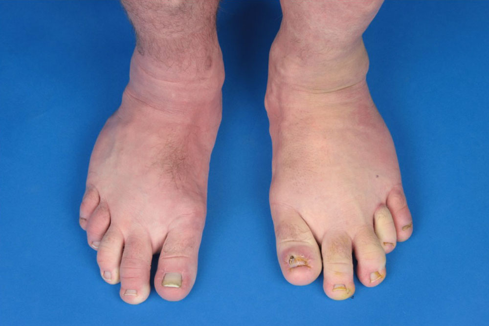 Ballooned hyperplasia of the feet in CLOVES syndrome