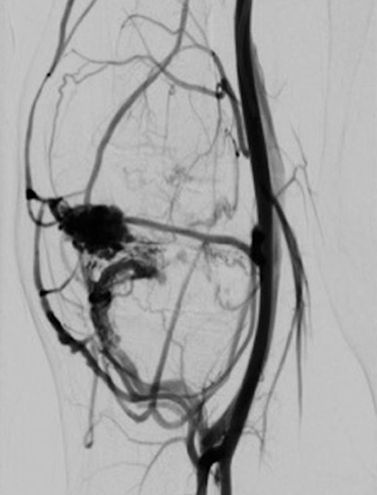 Digital subtraction angiography: PTEN hamartoma syndrome