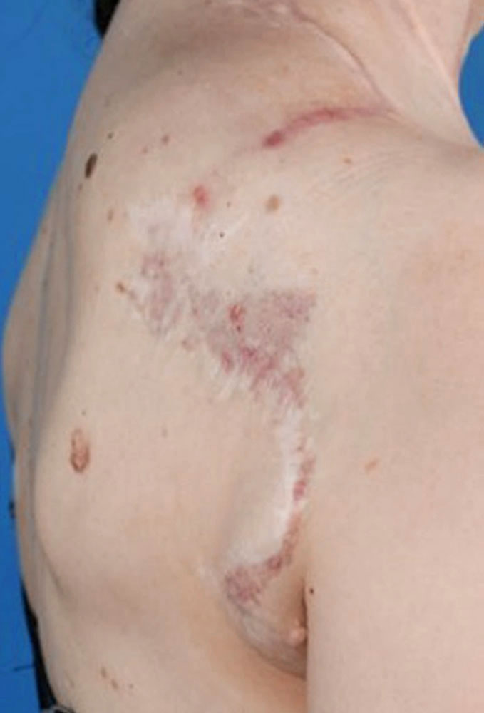 Surgical scars in PTEN hamartoma syndrome