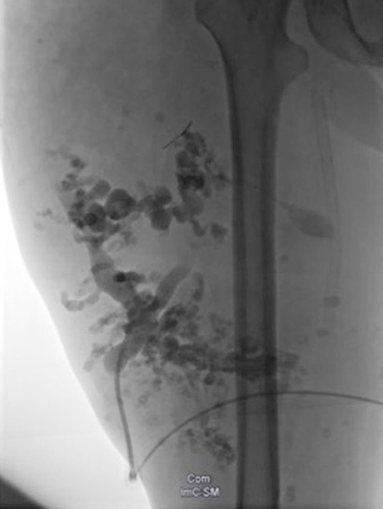 Small aneurysms in PTEN hamartoma syndrome
