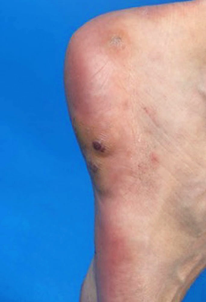 spindle cell hemangiomas on the foot