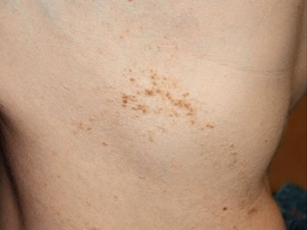 Epidermal nevus on the trunk
