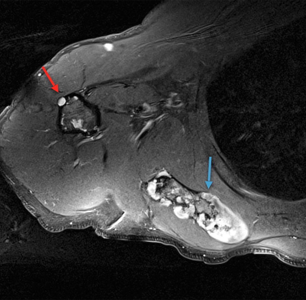 MRI of a Maffucci syndrome