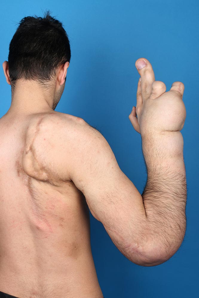 Fibrolipomatous gigantism of the right upper quadrant of the body