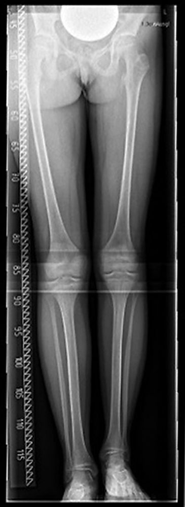 Whole-leg X-ray