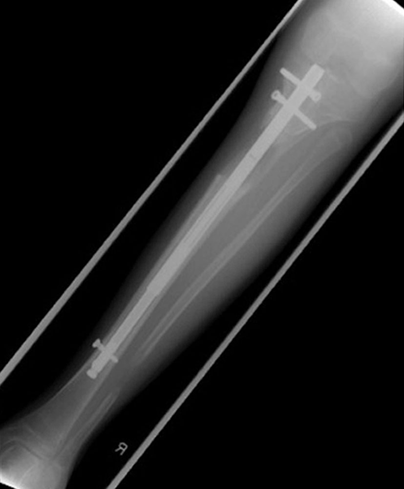 X-ray: Motor-driven internal extension nail