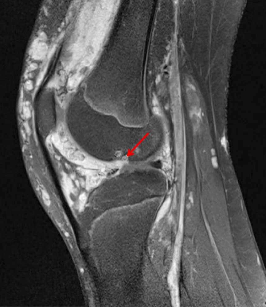 MRI: damage to the cartilage and underlying bone in angiodysplastic arthropathy
